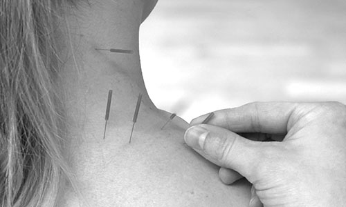 Akupunktur | FysioDanmark Randers